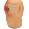 ONICOCRIPTOSIS