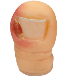 ONICOCRIPTOSIS