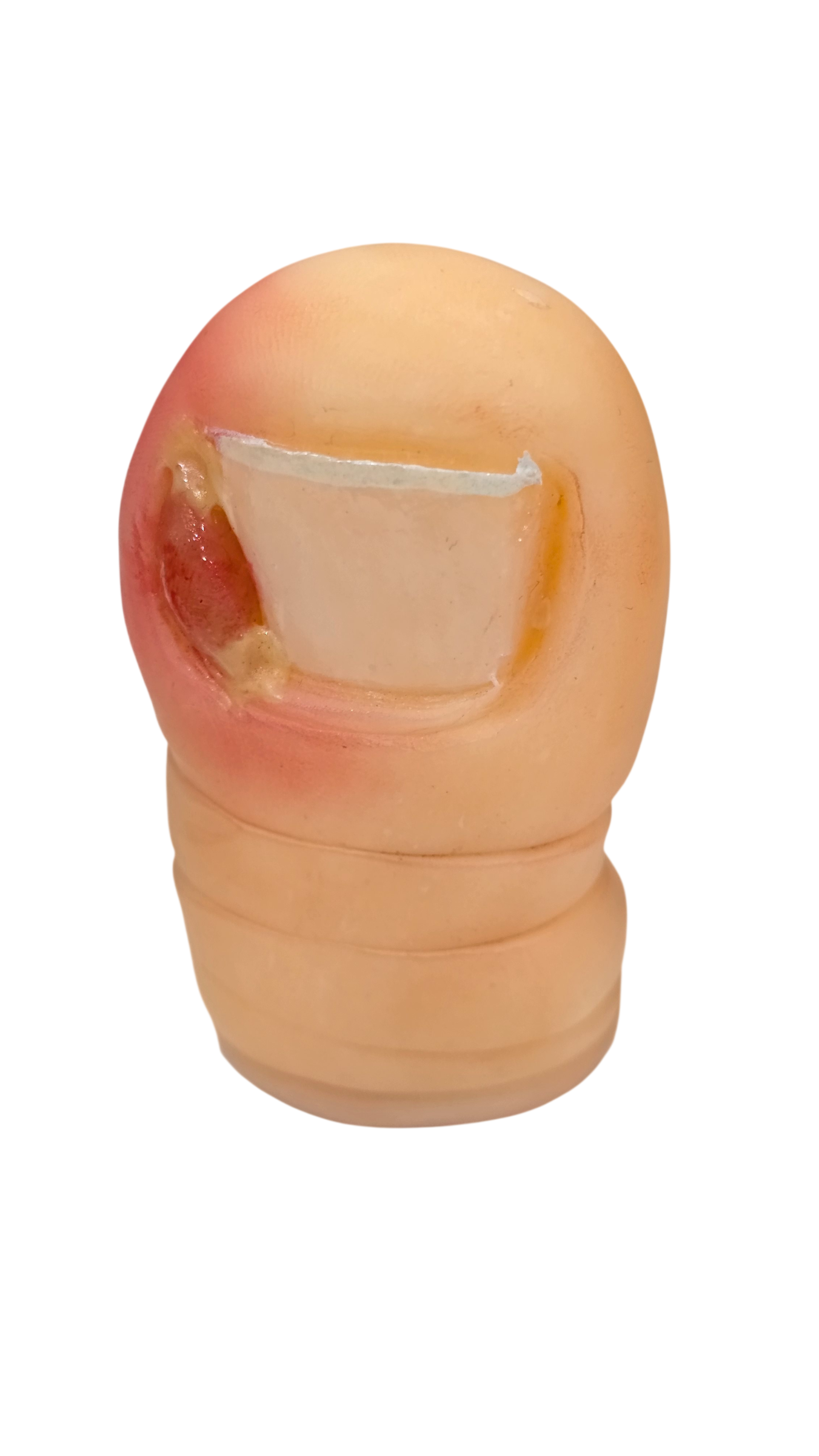 ONICOCRIPTOSIS