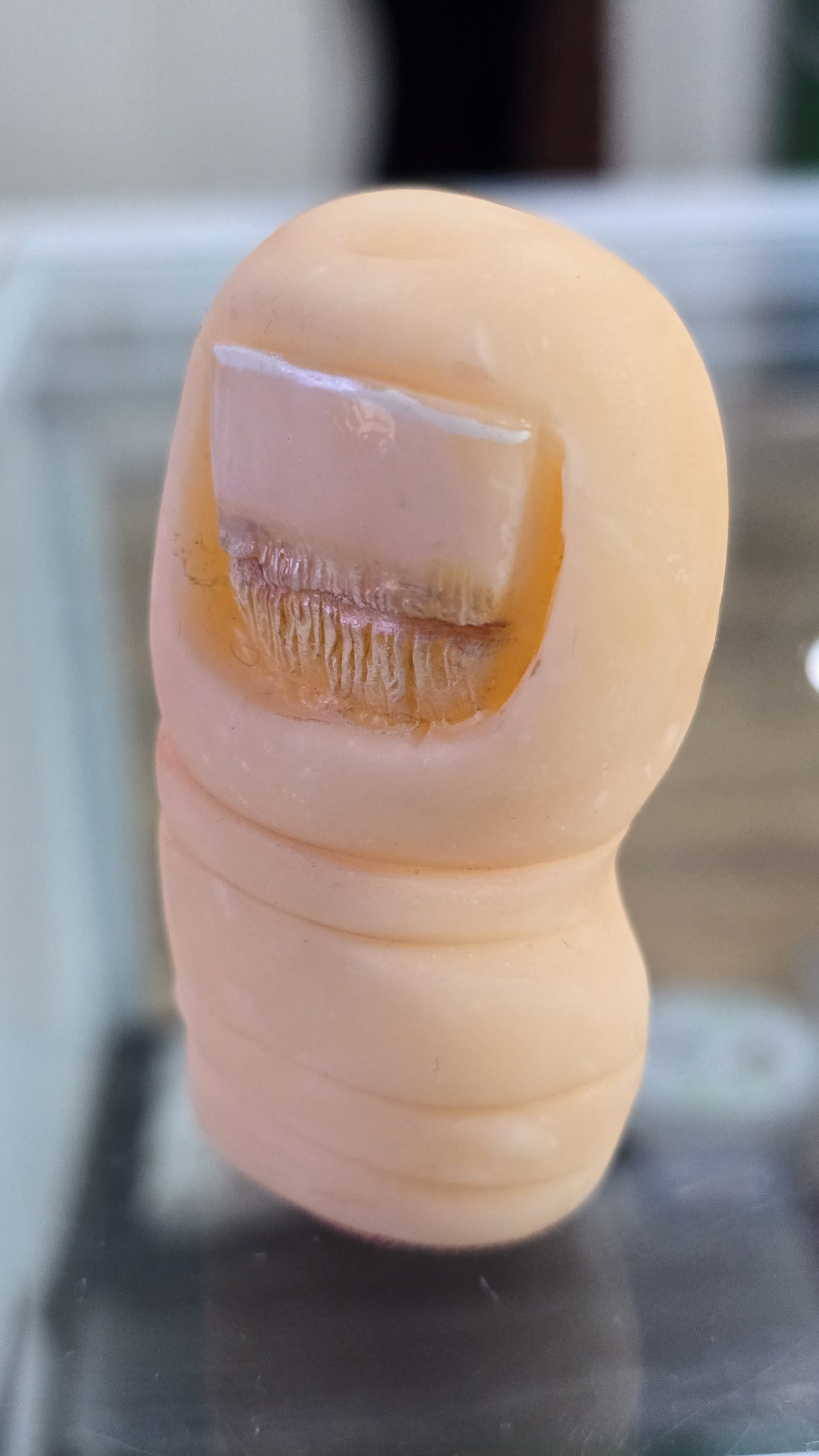 ONICOMICOSIS PROXIMAL - Imagen 2