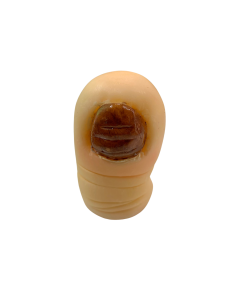 ONICOGRIFOSIS