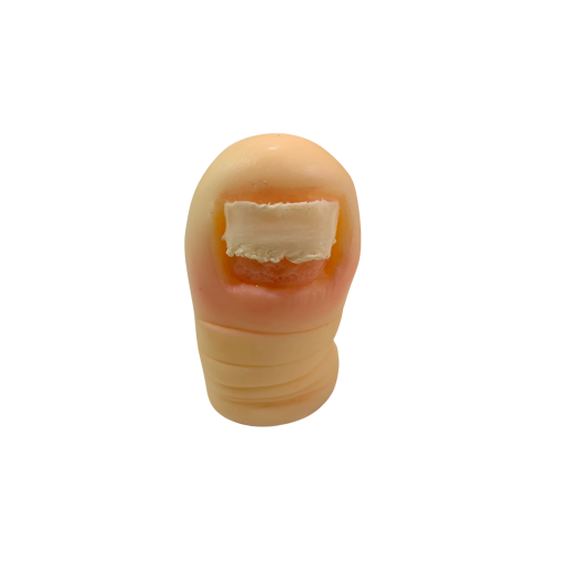 ONICOLISIS