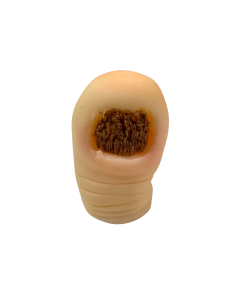 ONICOMICOSIS CON DISTROFIA