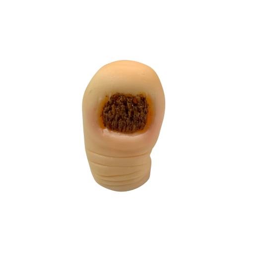 ONICOMICOSIS CON DISTROFIA