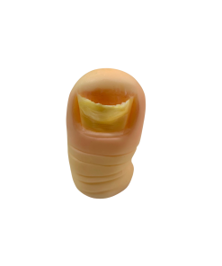 ONICOMICOSIS TOTAL