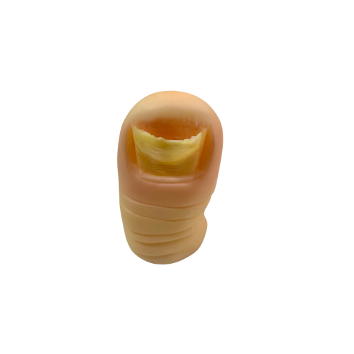 ONICOMICOSIS TOTAL