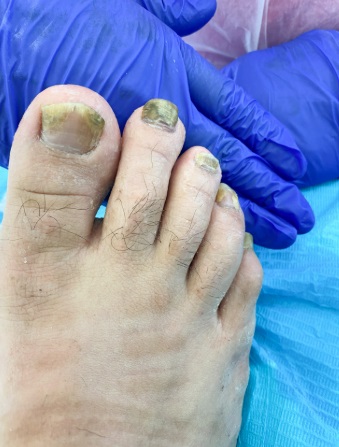 "PROMO 1 " UÑAS CON HONGOS: GOTAS CON TERBINAFINA 3% 10ML +10 MINI LIMAS + JABÓN ANTIMICOTICO - Imagen 2