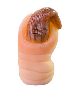 ONICOGRIFOSIS