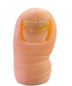 ONICOMICOSIS DISTAL