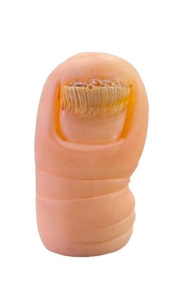 ONICOMICOSIS DISTAL